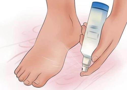 腳氣怎么治？腳氣不難治為何總復發？[漓峰]